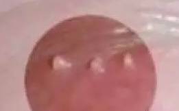 外阴长了很多小疙瘩